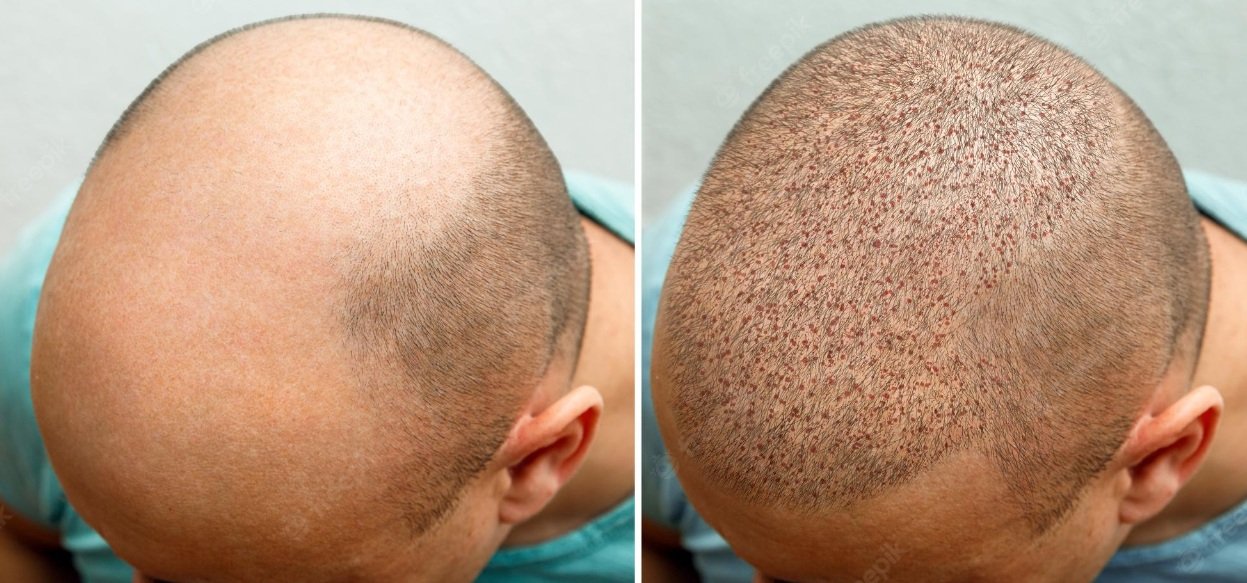 تكلفة زراعة الشعر